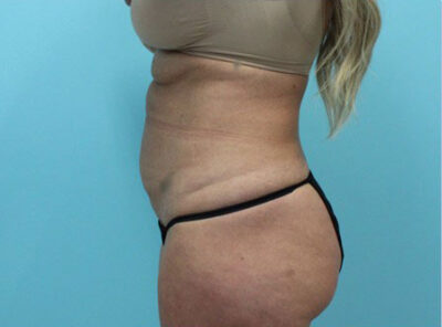 Abdominoplasty