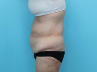 Abdominoplasty