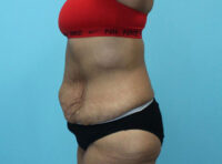 Abdominoplasty
