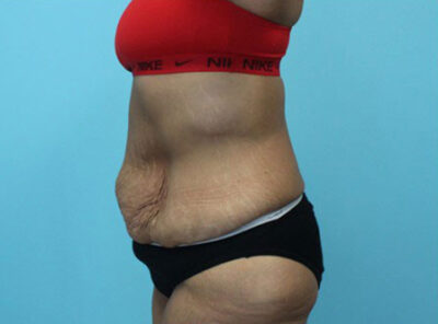 Abdominoplasty