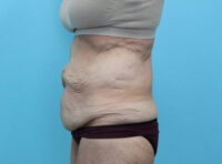 Abdominoplasty
