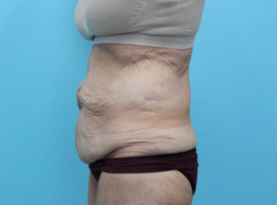 Abdominoplasty