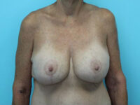 Augmentation & Mastopexy