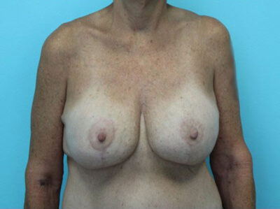 Augmentation & Mastopexy