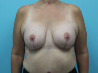 Augmentation & Mastopexy