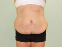 Abdominoplasty