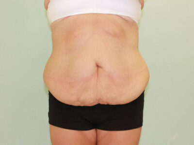 Abdominoplasty