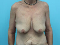 Augmentation & Mastopexy