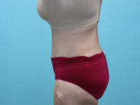 Abdominoplasty