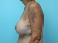 Augmentation & Mastopexy