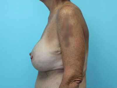 Augmentation & Mastopexy