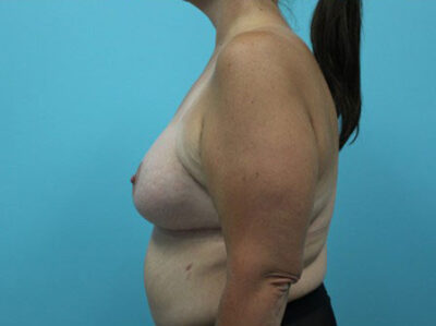 Augmentation & Mastopexy