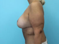 Augmentation & Mastopexy