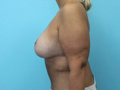 Augmentation & Mastopexy