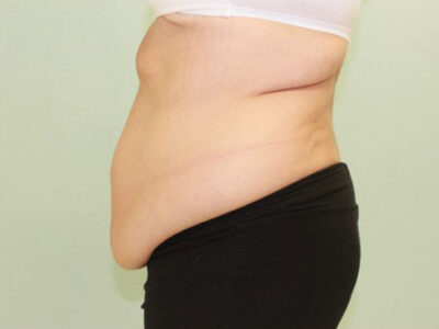 Abdominoplasty