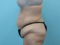 Abdominoplasty