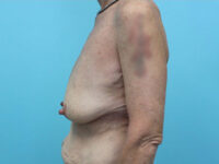 Augmentation & Mastopexy