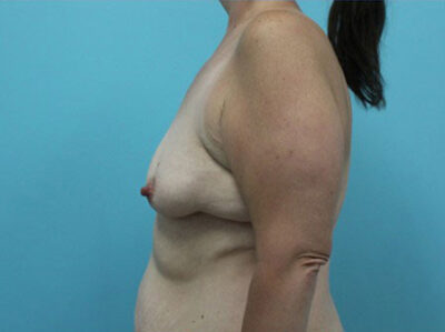 Augmentation & Mastopexy
