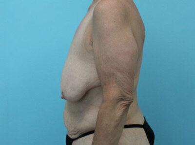 Augmentation & Mastopexy