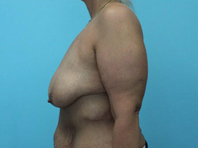 Augmentation & Mastopexy