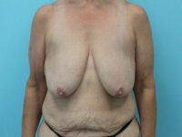 Augmentation & Mastopexy