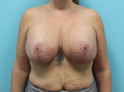 Augmentation & Mastopexy