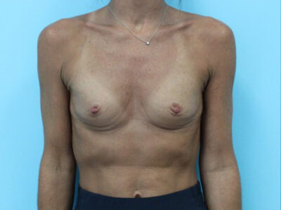 Breast Augmentation