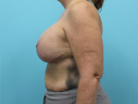 Augmentation & Mastopexy