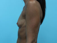 Breast Augmentation