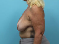 Augmentation & Mastopexy