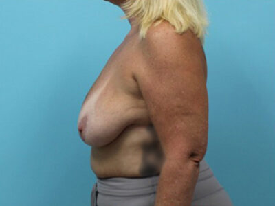 Augmentation & Mastopexy