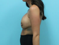 Breast Implant Exchange