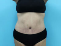 Abdominoplasty