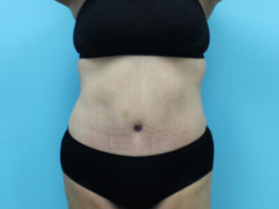 Abdominoplasty