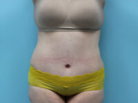Abdominoplasty