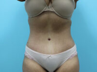 Abdominoplasty