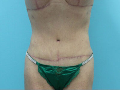 Abdominoplasty