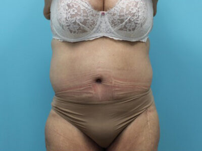 Abdominoplasty