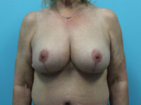 Augmentation & Mastopexy