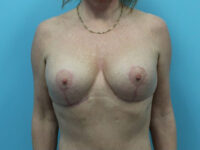 Augmentation & Mastopexy
