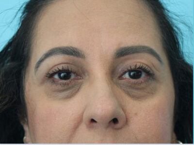 Blepharoplasty