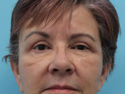 Blepharoplasty