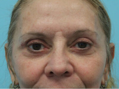 Blepharoplasty