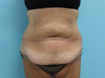 Abdominoplasty
