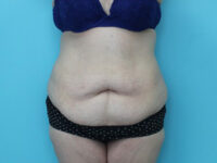 Abdominoplasty