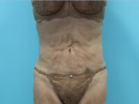 Abdominoplasty