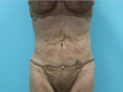 Abdominoplasty