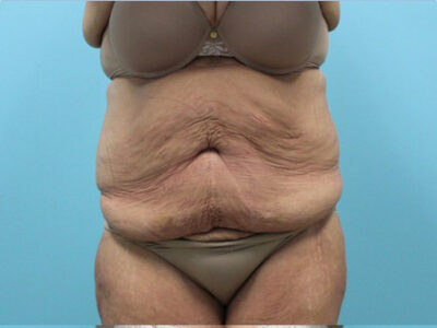 Abdominoplasty