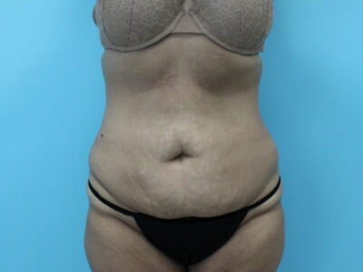 Abdominoplasty