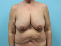 Augmentation & Mastopexy